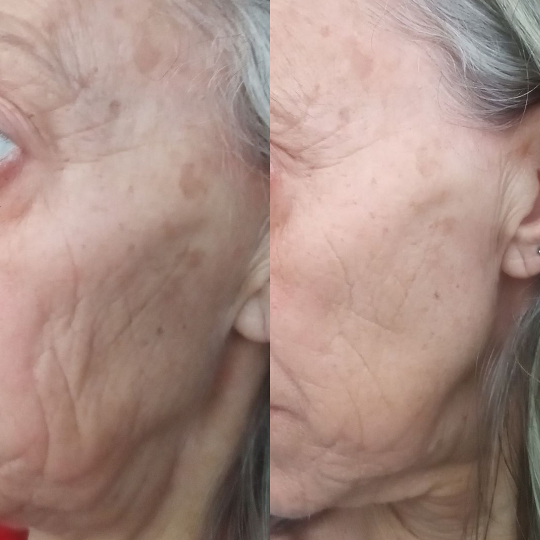 Side-by-side comparison of aged skin before and after treatment.