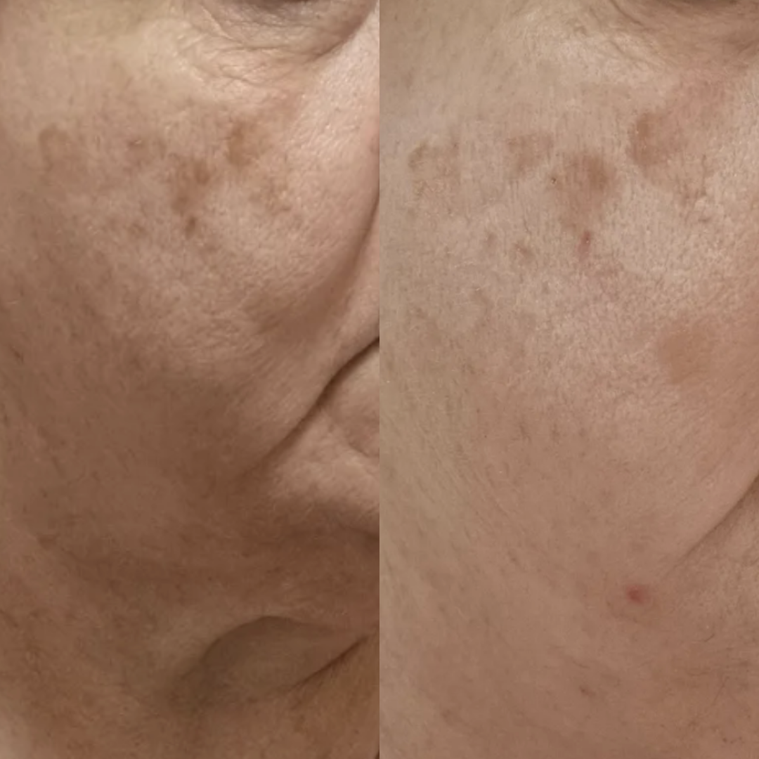 Before and after comparison of skin treatment showing reduced facial pigmentation.